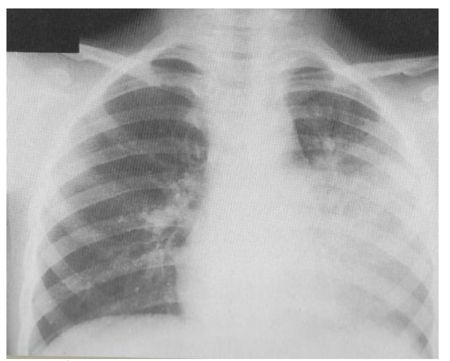 細気管支炎: 赤ちゃんの肺に影響を与える病気について学びましょう
