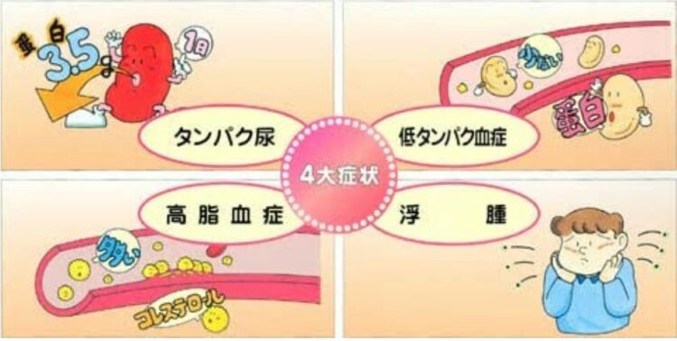 食事はネフローゼ症候群にどのような影響を与えますか?